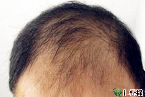 越来头发越少的八字特点