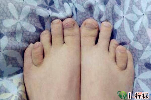 从脚趾长度看命运解析