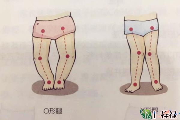 O型腿的男性命好吗