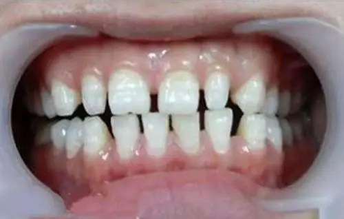 男人牙缝大命好吗