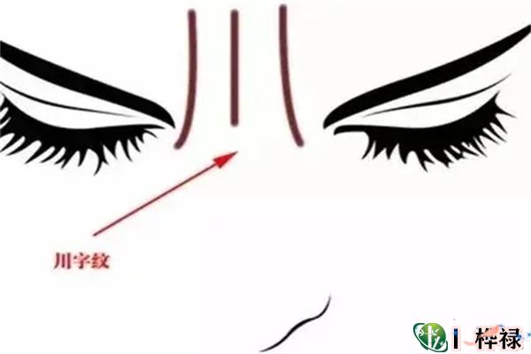 ​面部川字纹的人命好吗