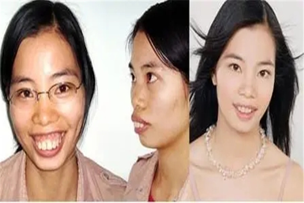 女人有龅牙命好吗