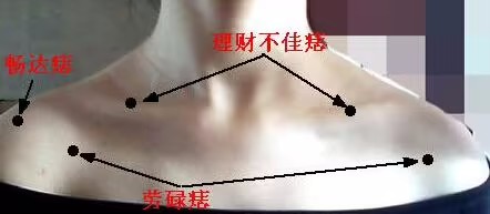 肩膀上长痣是什么意思