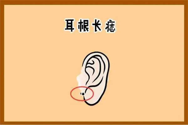 男人耳朵上长痣好吗