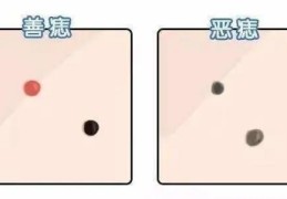 痣相中的十大凶痣