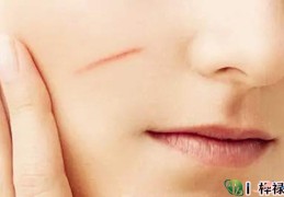 脸上有疤痕如何化解