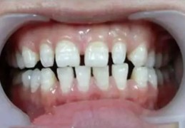 男人牙缝大命好吗