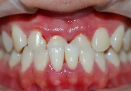 ​男人长龅牙命好吗