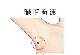 腋窝附近的痣代表什么